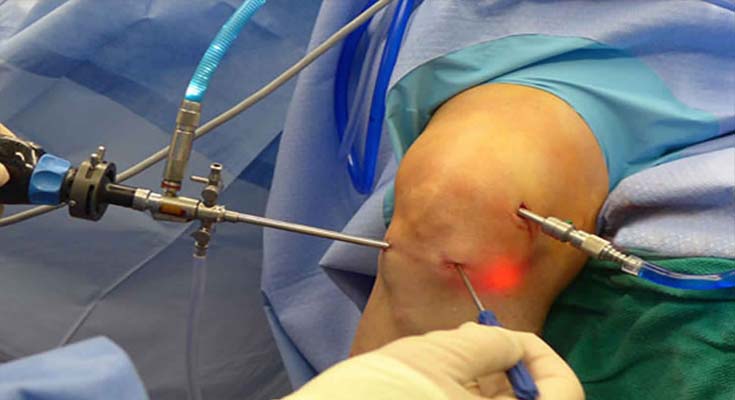 Acl Reconstruction Surgery in Delhi