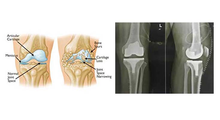 Knee Replacement Surgeon in Central Delhi